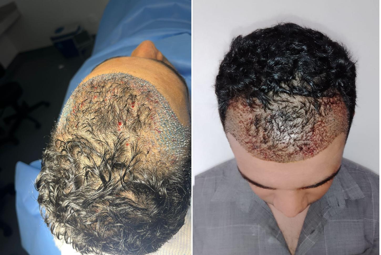 Médico realiza transplante capilar sem raspar a cabeça em Belo Horizonte